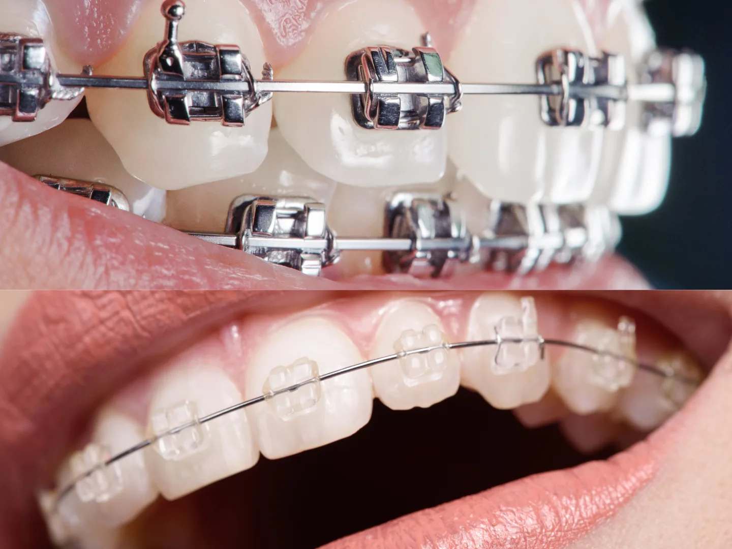 Metal braces & clear braces