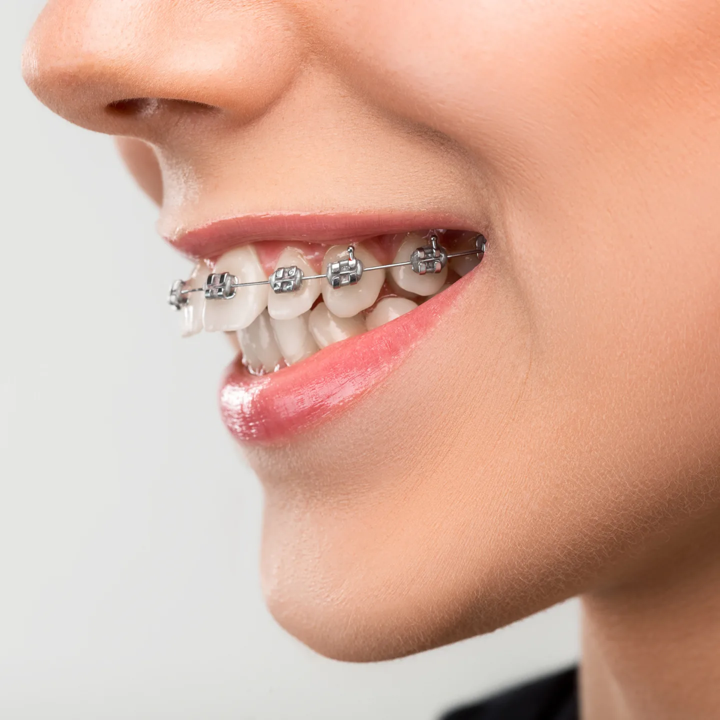 Teeth braces for adults
