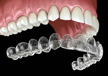cost of Invisalign for adults